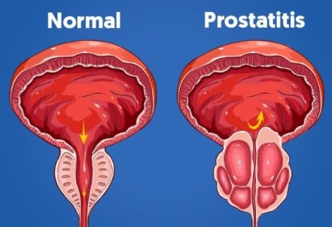 prostatitis